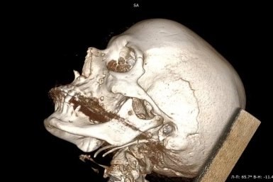 От редкой патологии избавили пациентку врачи хабаровской клиники