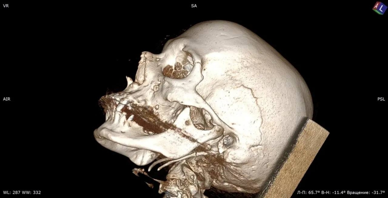 Синдром Игла-Стерлинга ККБ профессора Владимирцева