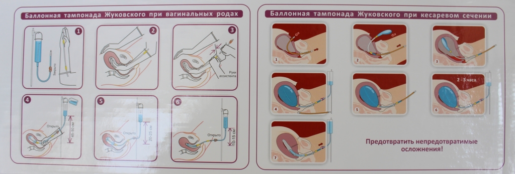 Баллонная тампонада