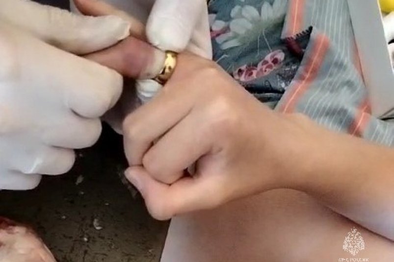 Снять тесное кольцо 15-летней хабаровчанке помогли спасатели